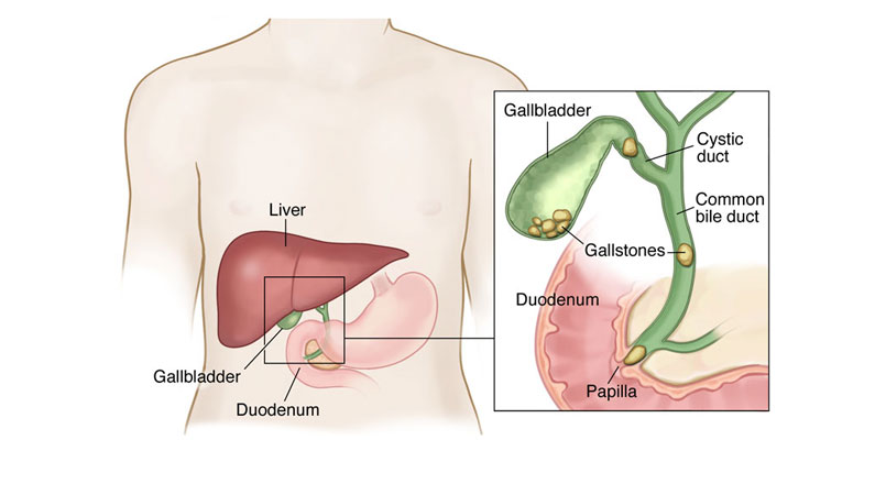 Bile Duct Stones Surgery in Bangalore