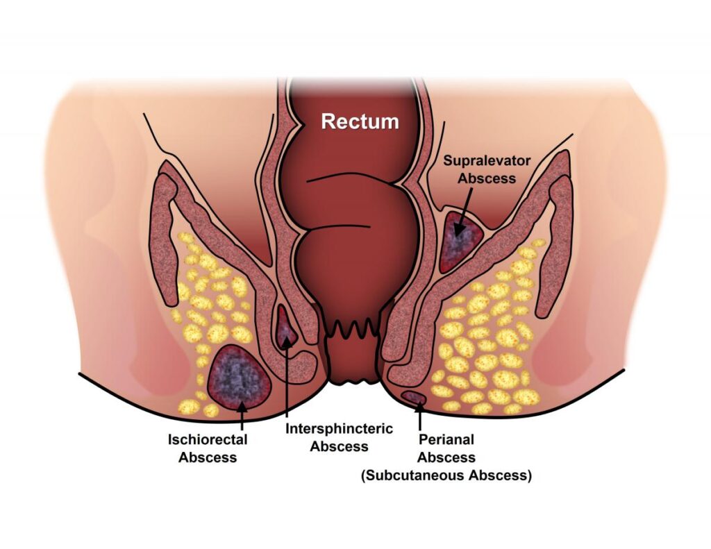 Anal Fistula Treatment in Bangalore